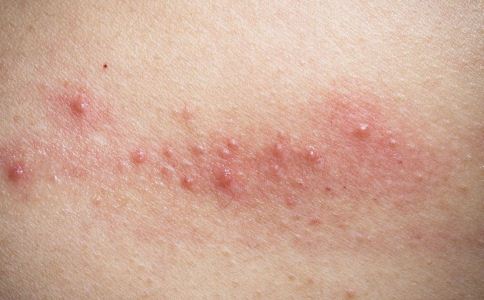 皮肤过敏红肿太痒了怎么办?_金华婺城皮肤病防治院【官网】