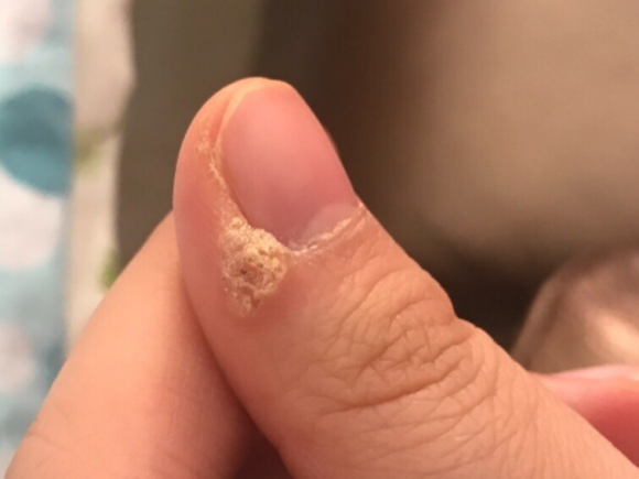 甲周疣怎么治疗_金华婺城皮肤病防治院【官网】